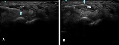 Ultrasound-Guided Nerve Hydrodissection With 5% Dextrose 4 Weeks After Steroid Injection in Treatment of Carpal Tunnel Syndrome: A Retrospective Study